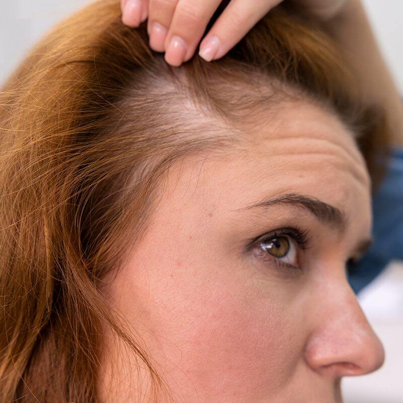 Hormonal Hair Loss in Women : A Guide For Hair Professionals